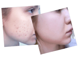 olena acne, olena before and after, pop the pimple