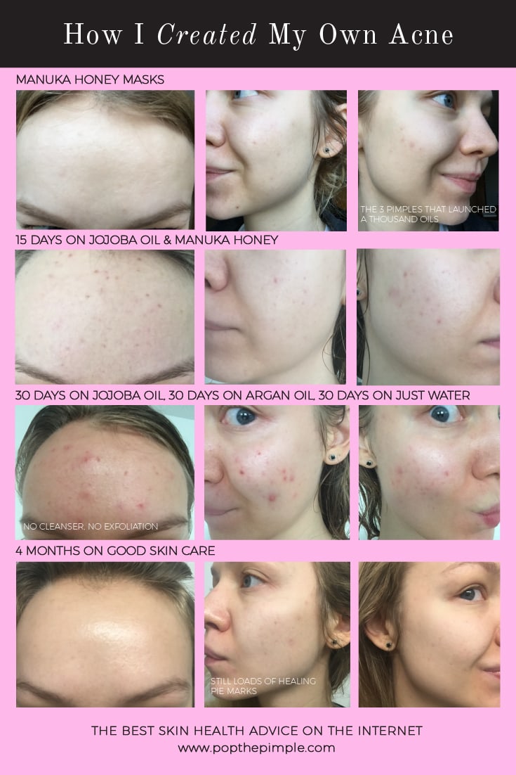 acne-prone skin before and after, popthepimple, best acne blog, acne healing results